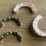Zirconia-Hybrid-on-Pure-titanium-implant-bar-2